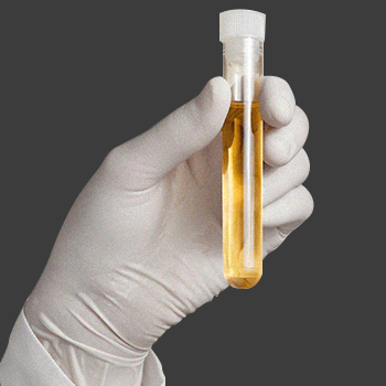 A hand with surgical gloves holding a urine sample