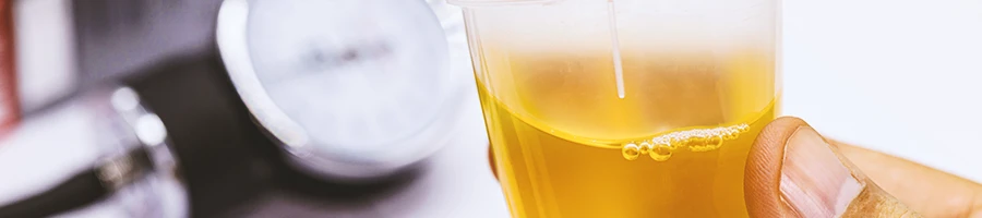 A person holding a urine sample