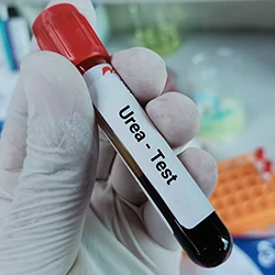 A doctor holding a test tube labeled as urea